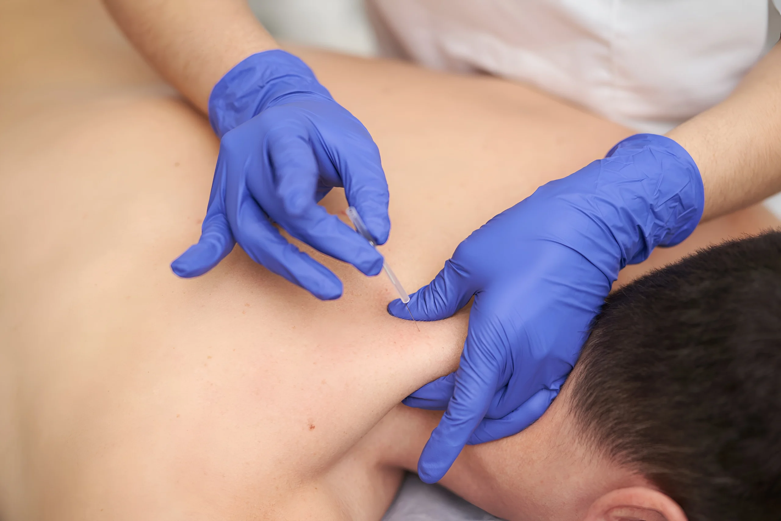 Dry Needling Castle Hill